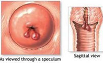 什么是宮頸息肉