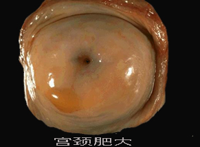 為什么會宮頸肥大？