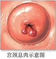 如何辨別宮頸息肉