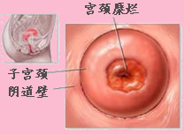 宮頸糜爛分為幾種類型
