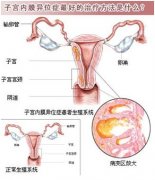 德國wolf宮腹腔鏡聯合術   讓女人告別子宮內膜異位癥